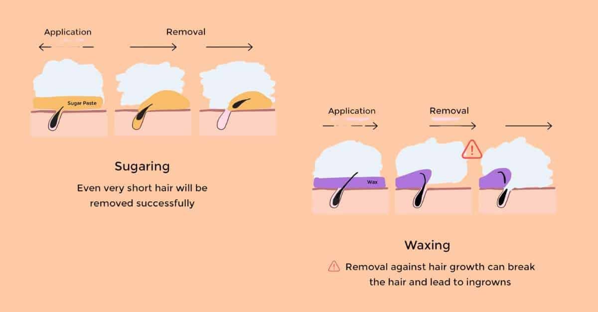 Showing difference between Brazilian Sugaring Vs Wax For Sensitive Skin