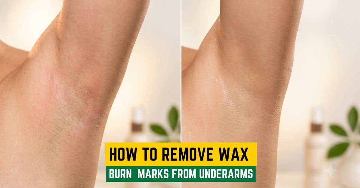 How to Remove Wax Burn Marks From Underarms: Safe Treatment & Prevention Guide 